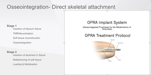 Figure 1-Alfred Osseointegration protocol