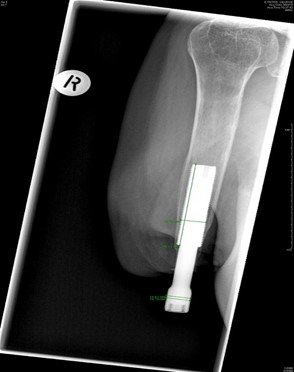 Figure 2 - second stage x-ray