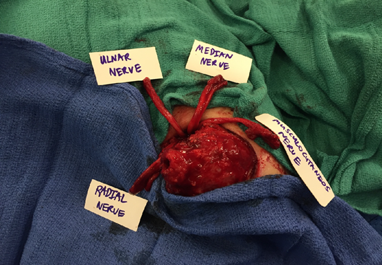 Figure 6-Proximal transhumeral amputation
