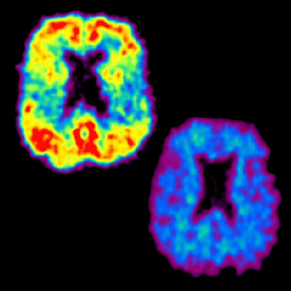 Wikipedia_amyloidPET